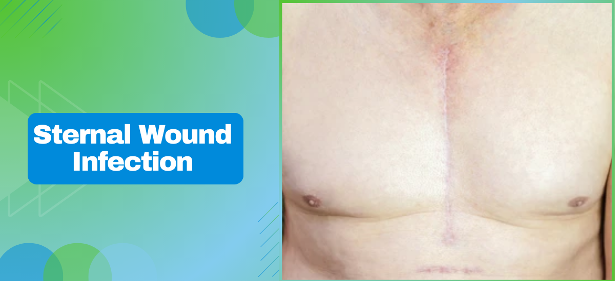Sternal Wound Infection