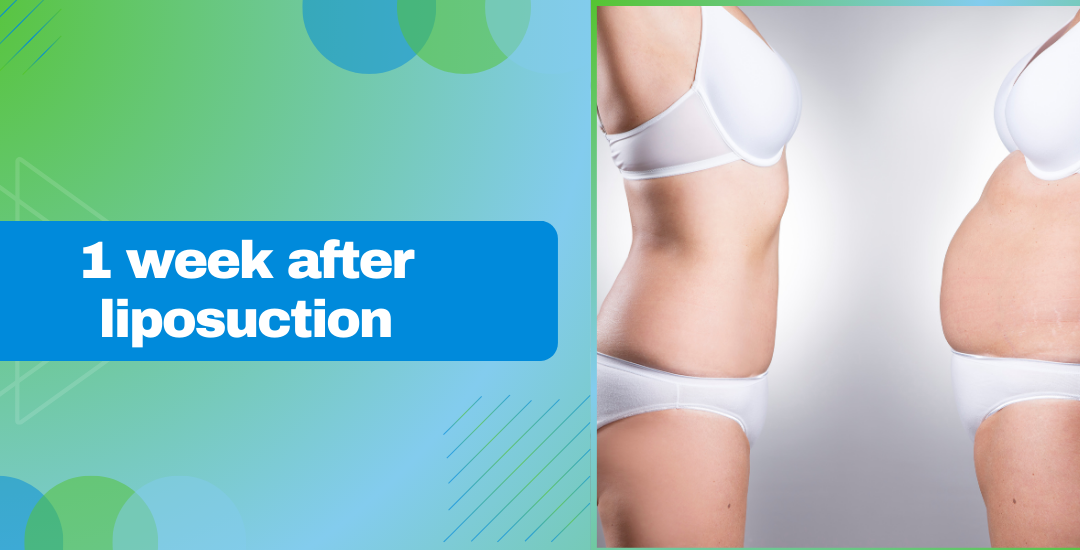 1 week after liposuction | Dr. Leena Jain