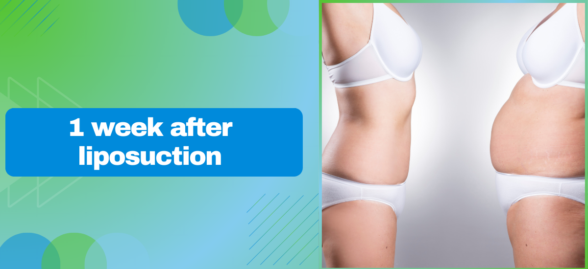 1 Week After Liposuction