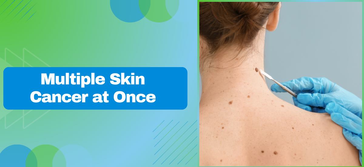 Multiple Skin Cancers at Once