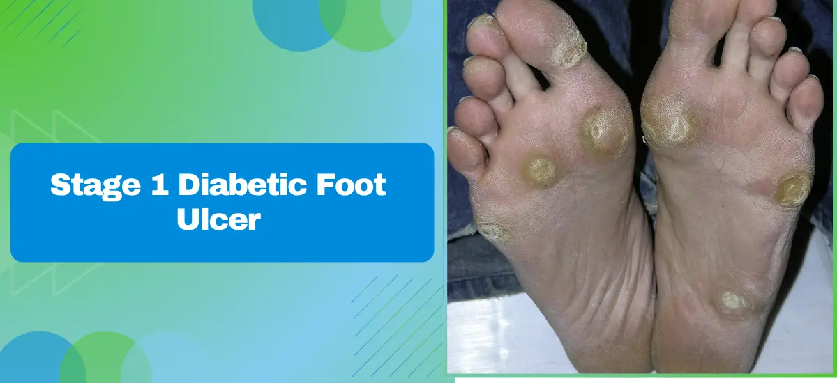 Stage 1 Diabetic Foot Ulcer