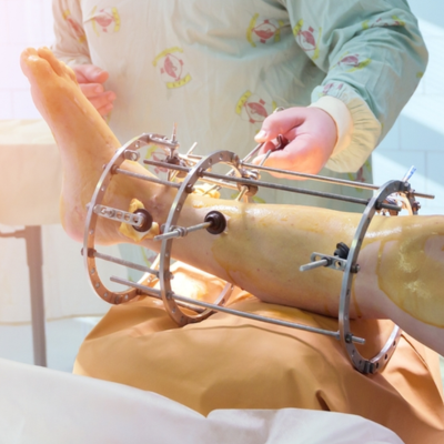 Limb_Reconstruction