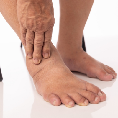 Lymphedema