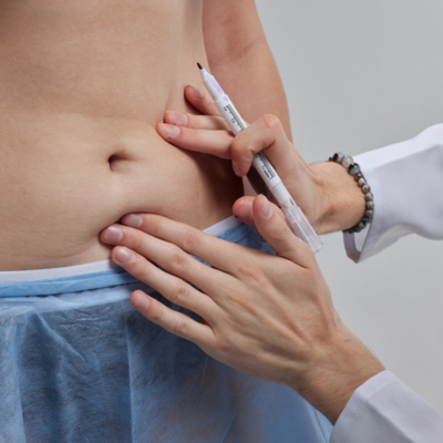 Tummy_Tuck