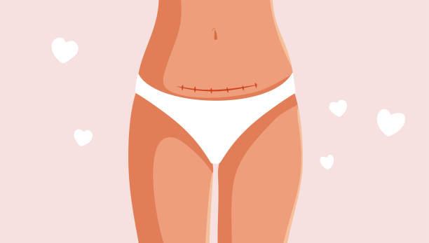 What is Free Flap Reconstruction?