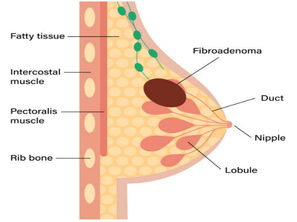 What is a Fibroadenoma? What is a Fibroadenoma?