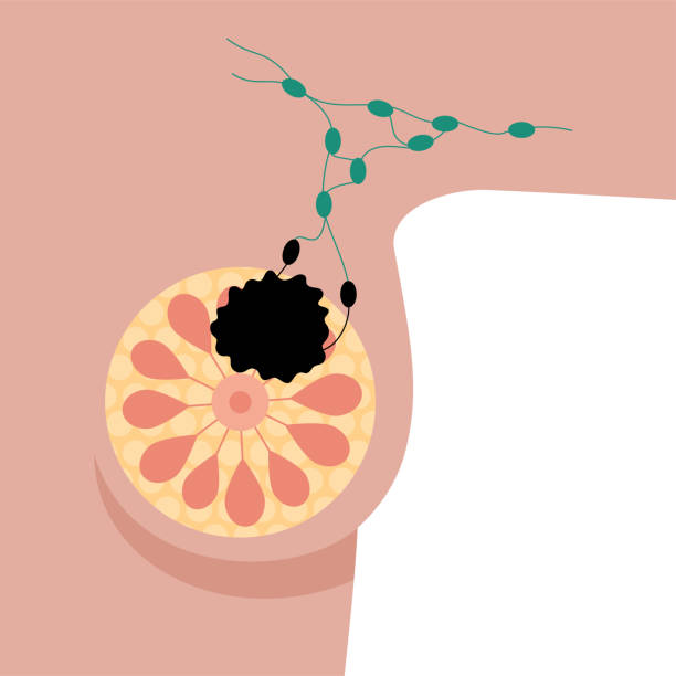 Risk of Malignancy