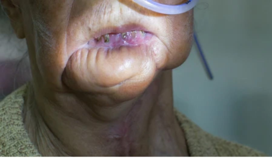 What is Free Flap Reconstruction? What is Free Flap Reconstruction?