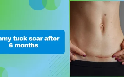 Tummy tuck scar after 6 months