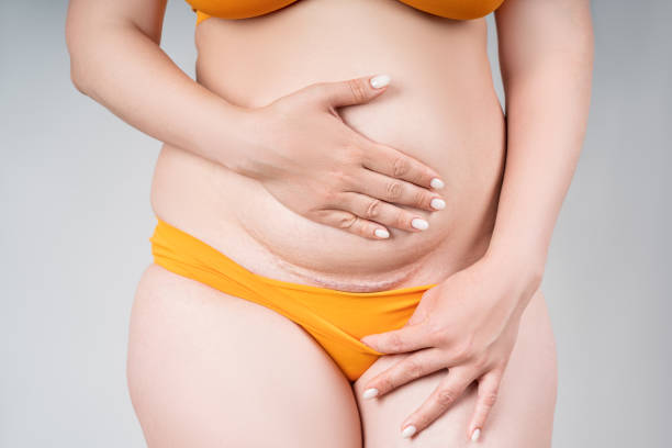 Dr. Leena Jain - Plastic surgeon in mumbai tummy tuck