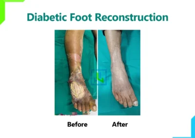 Diabetic foot ulcer before and after Diabetic foot ulcer before and after
