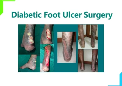 Diabetic foot ulcer before and after Diabetic foot ulcer before and after