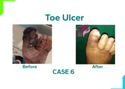 Diabetic foot ulcer before and after Diabetic foot ulcer before and after