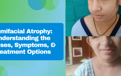 Hemifacial Atrophy: Understanding the Causes, Symptoms, and Treatment Options