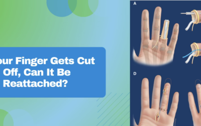 If Your Finger Gets Cut Off, Can It Be Reattached?