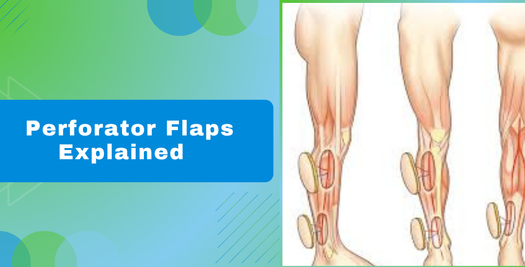 Perforator Flaps Explained