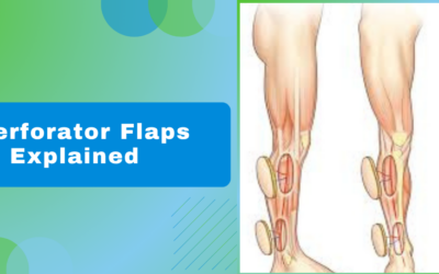 Perforator Flaps: Moving Your Own Tissue to Heal a Wound