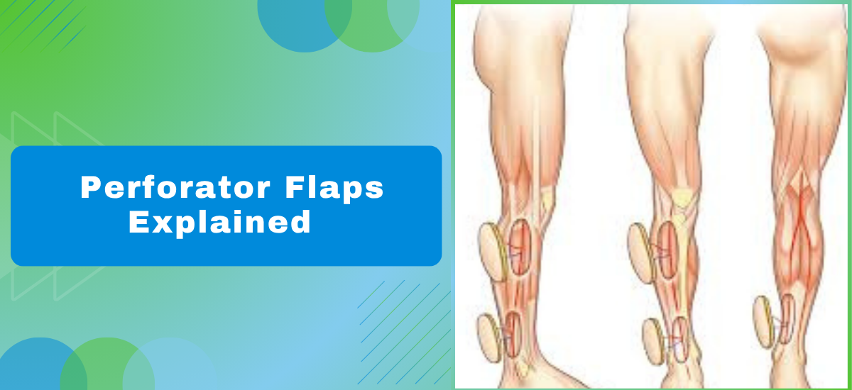 Perforator Flaps Explained