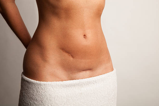 4 Weeks Post Tummy Tuck