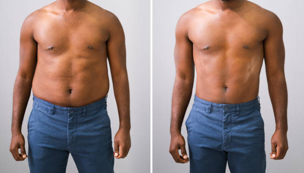 Results & Improvements 4 Weeks Post Tummy Tuck