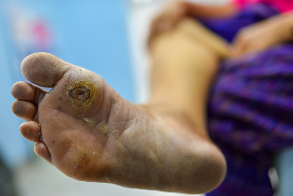 68388cd8c8 - Dr Leena Jain Close-up of a dirty sole with a circular wound near the big toe; blurred person in purple clothing in the background.