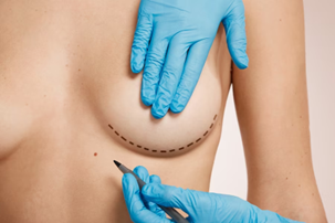 Breast-Conservation-Surgery - Dr Leena Jain Preoperative markings on a woman's chest for breast surgery, drawn with a marker by a surgeon wearing blue gloves.