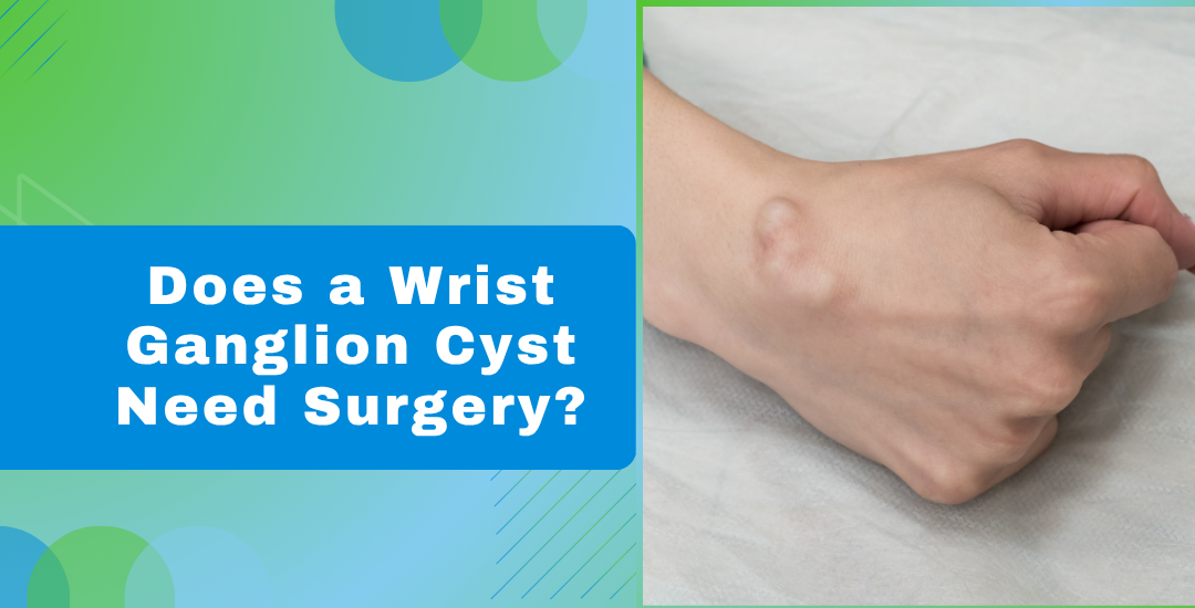 Does a Wrist Ganglion Cyst Need Surgery