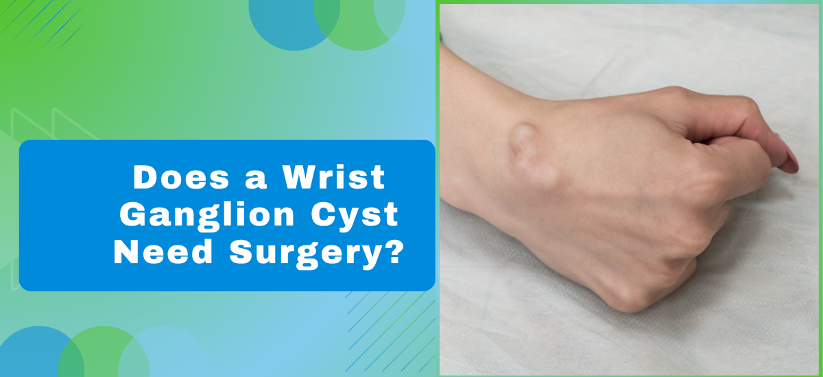 Does a Wrist Ganglion Cyst Need Surgery?