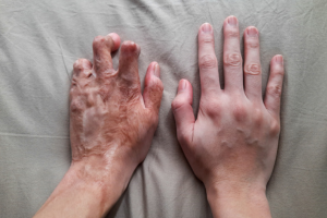 Untitled-design-22 - Dr Leena Jain Two hands rest side by side on a fabric surface: an older, wrinkled hand with prominent veins beside a younger, smooth hand.