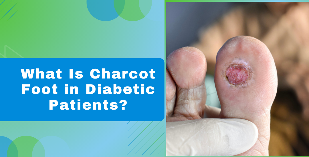 What Is Charcot Foot in Diabetic Patients