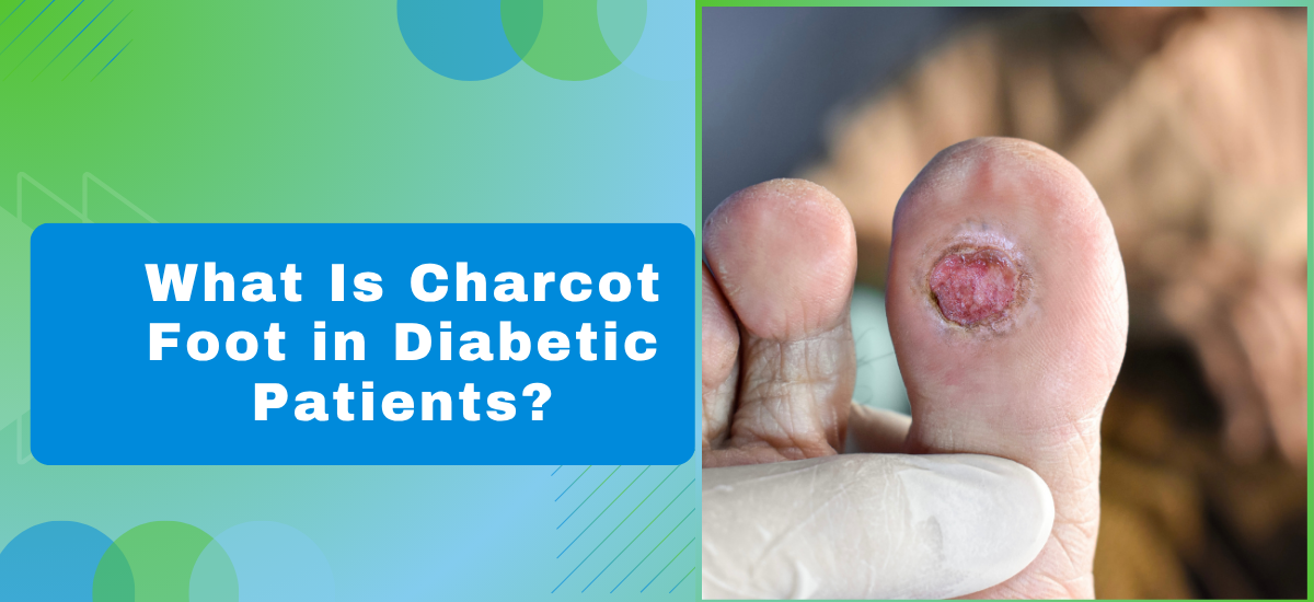 What Is Charcot Foot in Diabetic Patients?