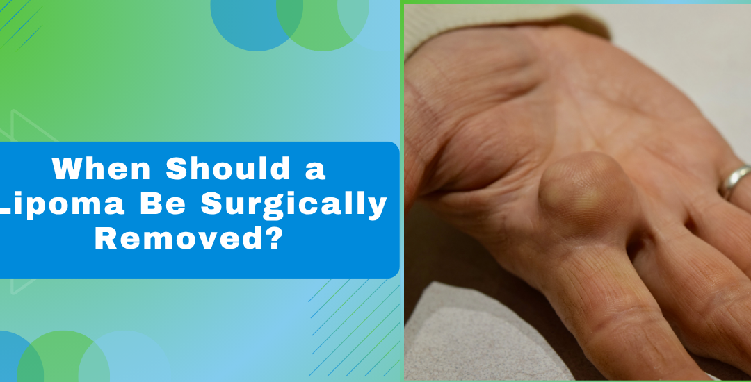 When Should a Lipoma Be Surgically Removed