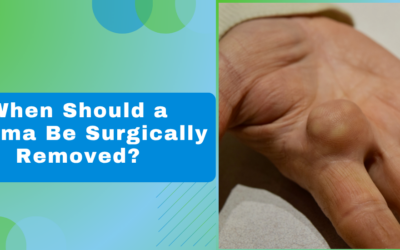 When Should a Lipoma Be Surgically Removed?
