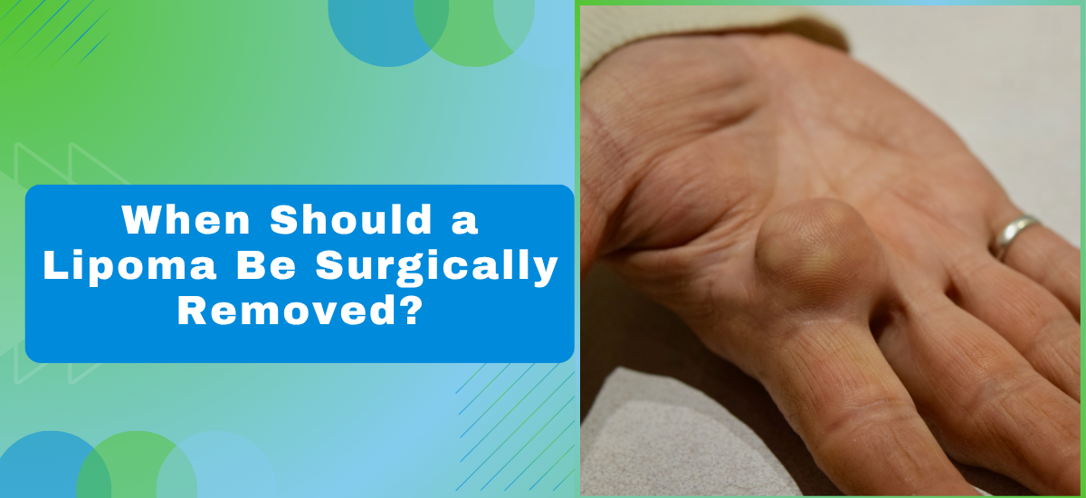 When Should a Lipoma Be Surgically Removed - Dr Leena Jain When Should a Lipoma Be Surgically Removed