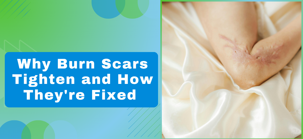 Why Burn Scars Tighten and How They’re Fixed?