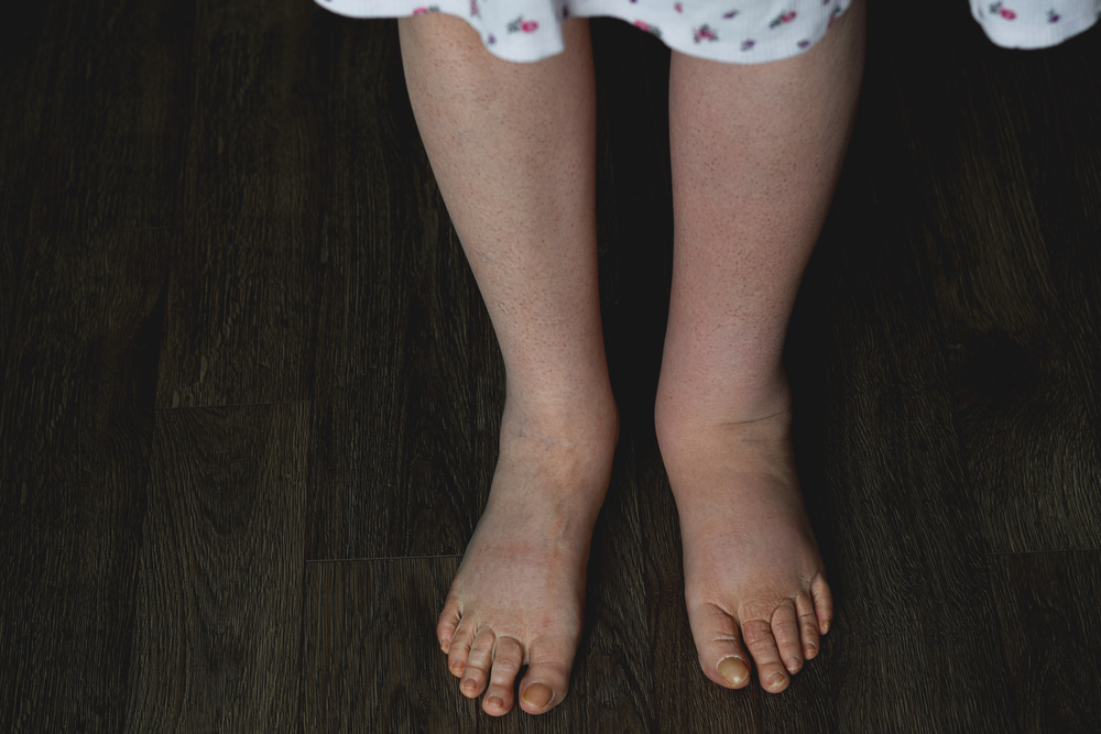 FemaleLegsAffectedByLymphedemaCondition - Dr Leena Jain Child's bare feet on dark wooden floor, wearing a light dress with small pink flowers edge visible at the top.
