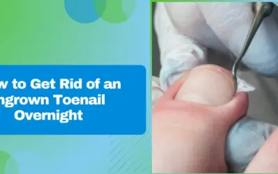 How to Get Rid of an Ingrown Toenail Overnight