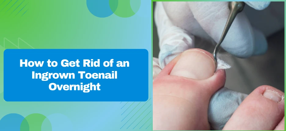 Guide-style cover image: 'How to Get Rid of an Ingrown Toenail Overnight' with a close-up of a medical procedure on the right.