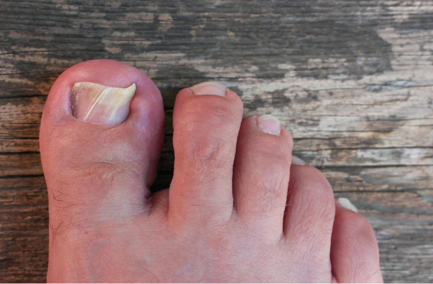 Close-up of a big toe and other toes with damaged toenail on a weathered wooden floor surface.
