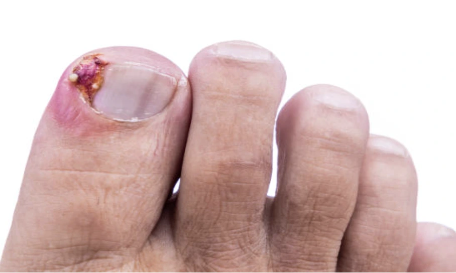 Close-up of a big toe with a damaged, partially torn toenail and a scab on the nail bed, showing surrounding redness