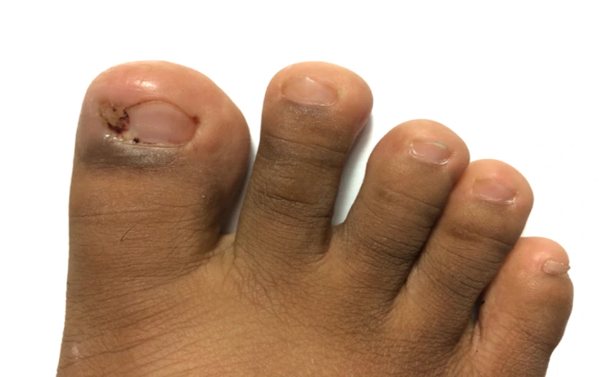 Close-up of a toe with a damaged big toenail and surrounding skin bruising/abrasion.