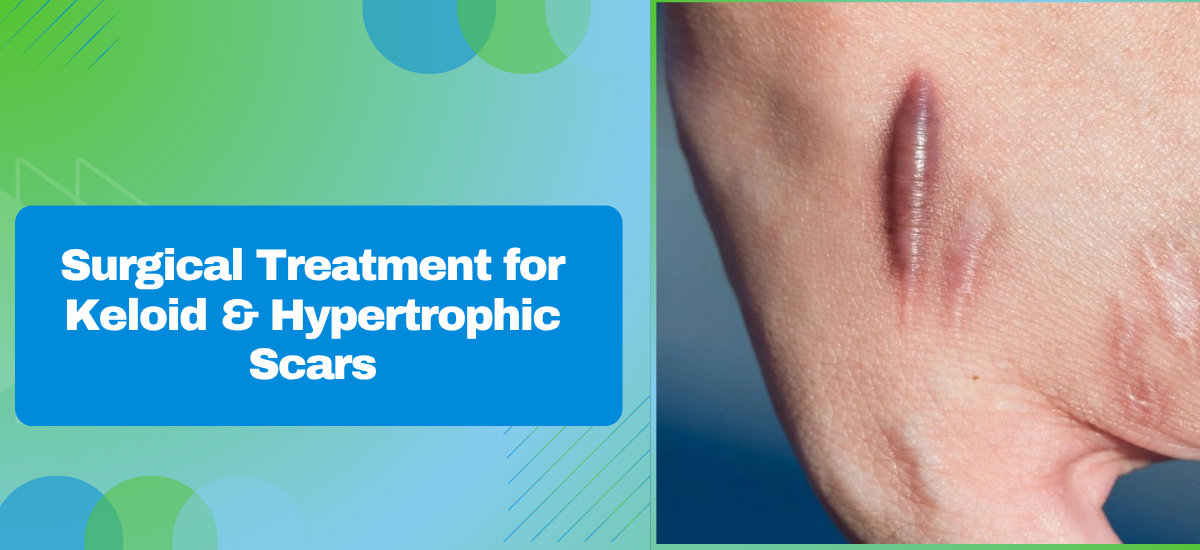 Can Keloid and Hypertrophic Scars Be Surgically Treated?