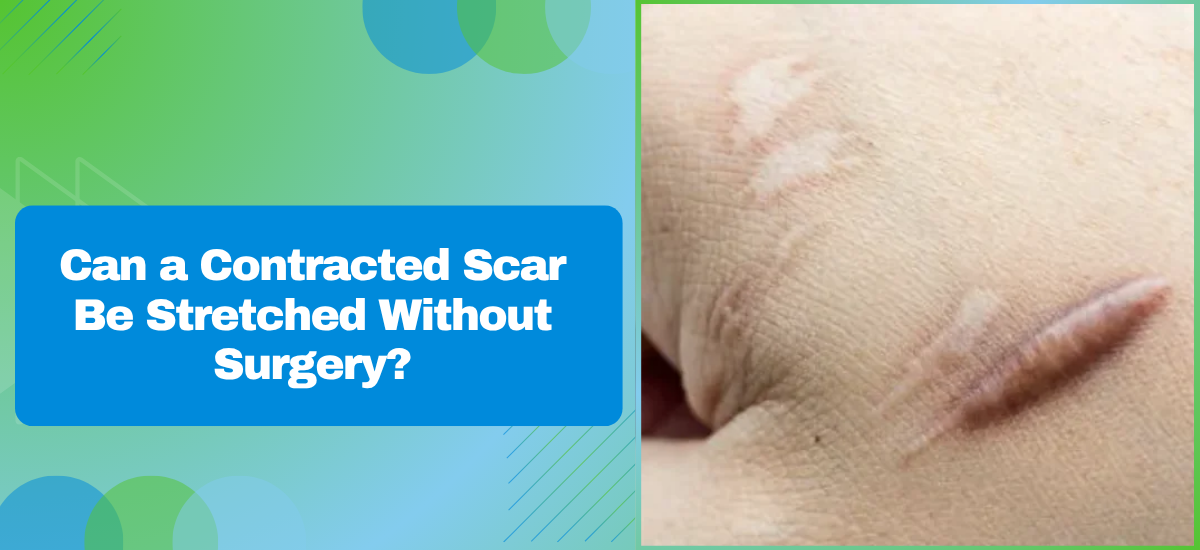 Can a Contracted Scar Be Stretched Without Surgery?