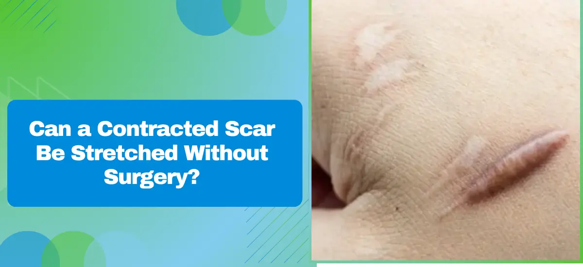 Can a Contracted Scar Be Stretched Without Surgery?