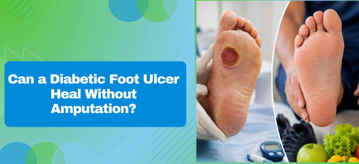 Can a Diabetic Foot Ulcer Heal Without Amputation?