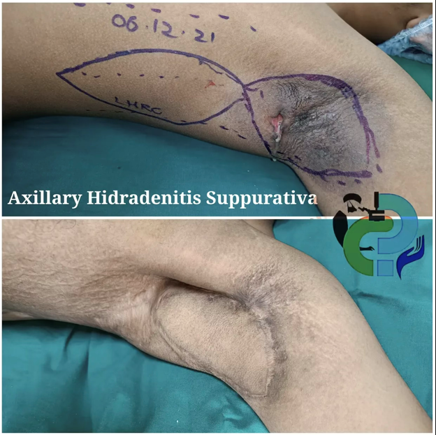 Picture4 - Dr Leena Jain Arm with purple surgical markings outlining an axillary hidradenitis suppurativa excision area; inflamed skin and post-marking incision region visible.