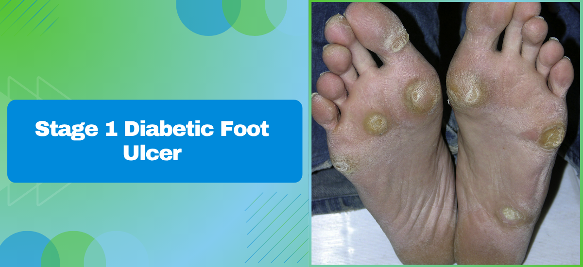 Stage 1 Diabetic Foot Ulcer