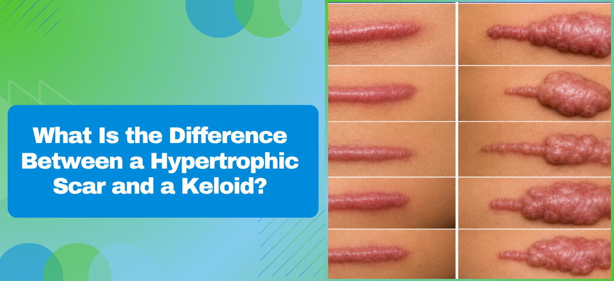 What Is the Difference Between a Hypertrophic Scar and a Keloid?