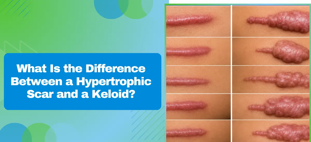 What Is the Difference Between a Hypertrophic Scar and a Keloid?
