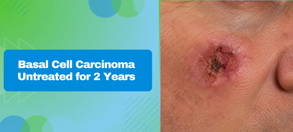 Basal Cell Carcinoma Untreated for 2 Years (Search Volume: 8.5k)